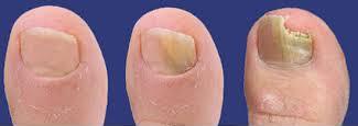 Tratament pentru unghii galbene la picioare