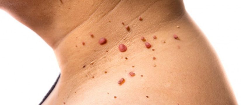 Trebuie să îndepărtez papilomele sub sân, Tot ce trebuie sa stii despre HPV: Simptome & Tratament