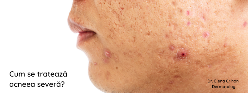 Cum se tratează acneea severă?